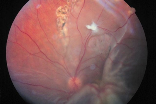 Descolamento de retina tracional
